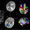 Dies zeigt perinatale Gehirnscans, die Bereiche hervorheben, die mit Autismus in Verbindung stehen
